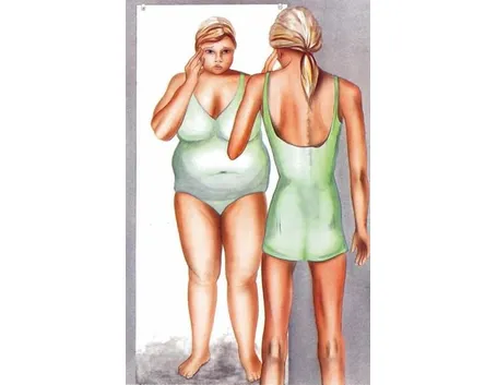 Anoressia