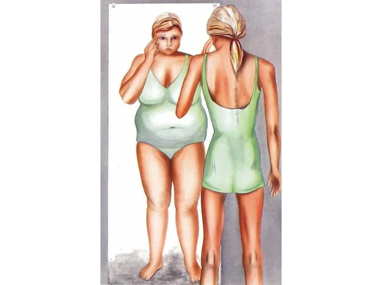 Anoressia
