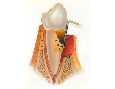 Piorrea