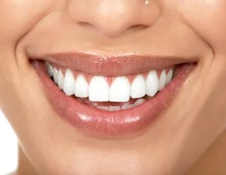 Sbiancamento dentale