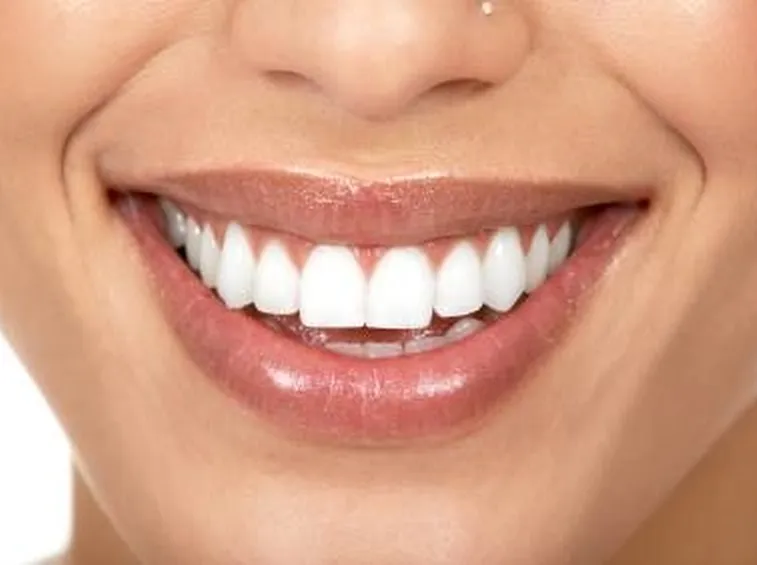 Sbiancamento dentale