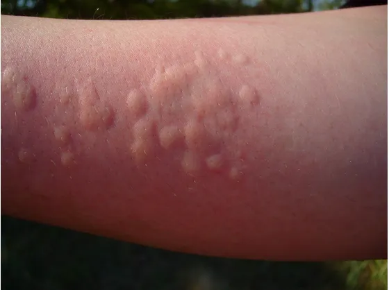 Orticaria