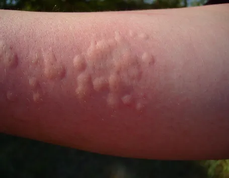 Orticaria