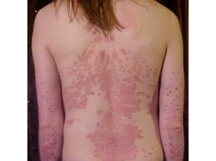 Psoriasi