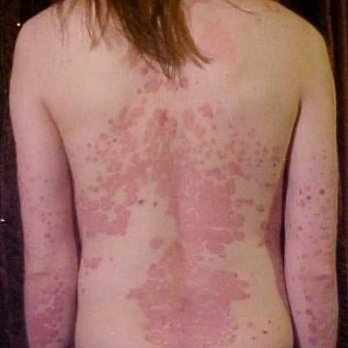 Psoriasi