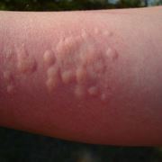 Orticaria