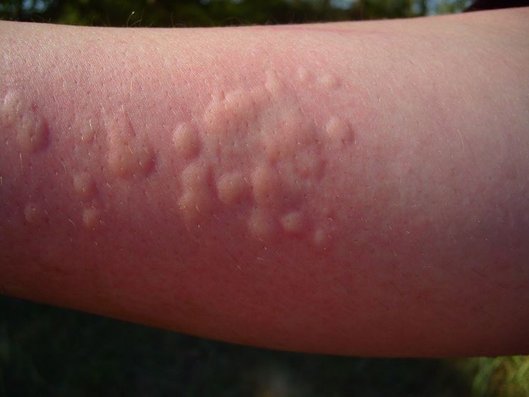 Orticaria