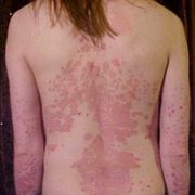 Psoriasi